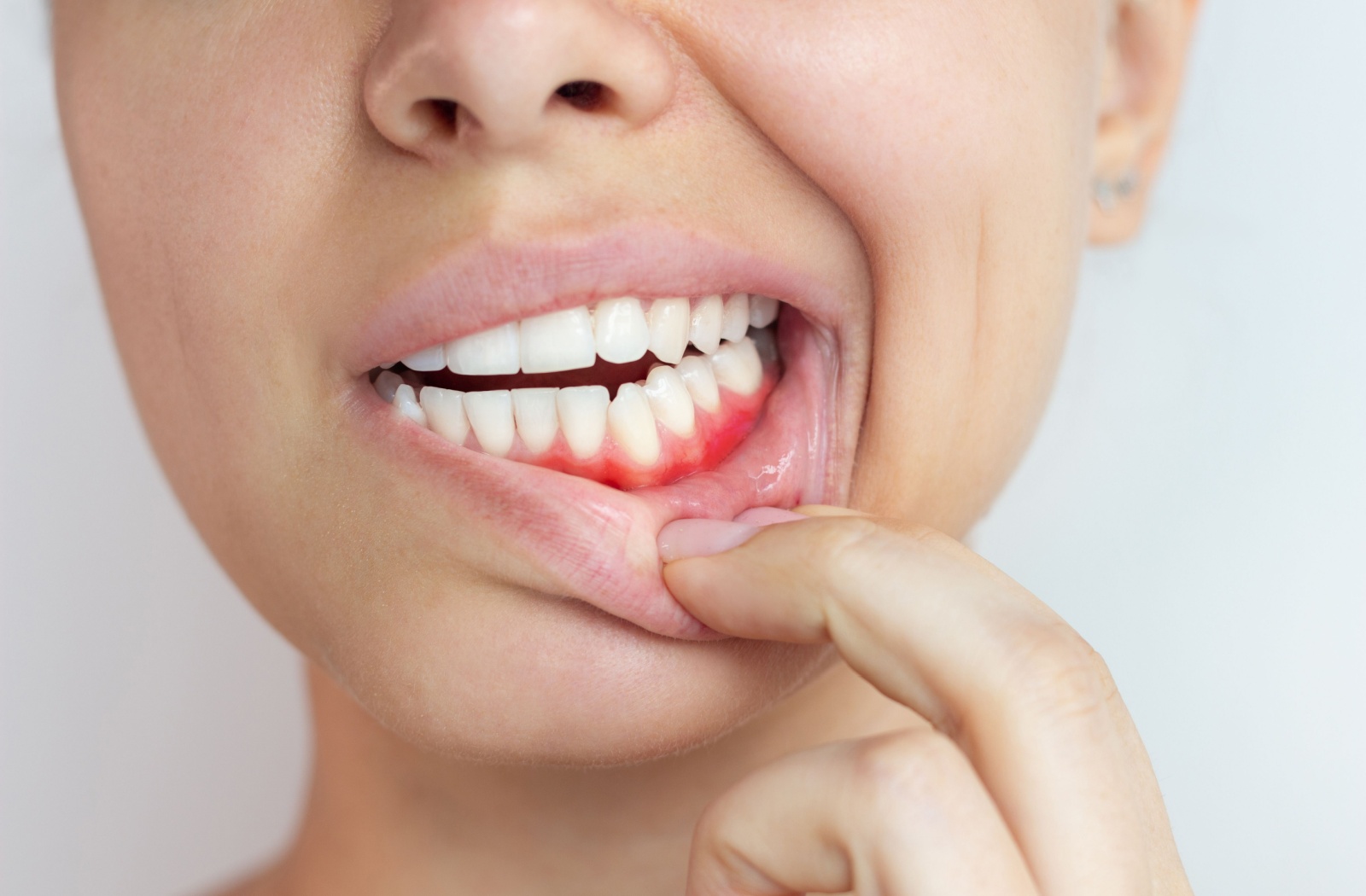 A person pulls down their lips to reveal red, swollen gums.