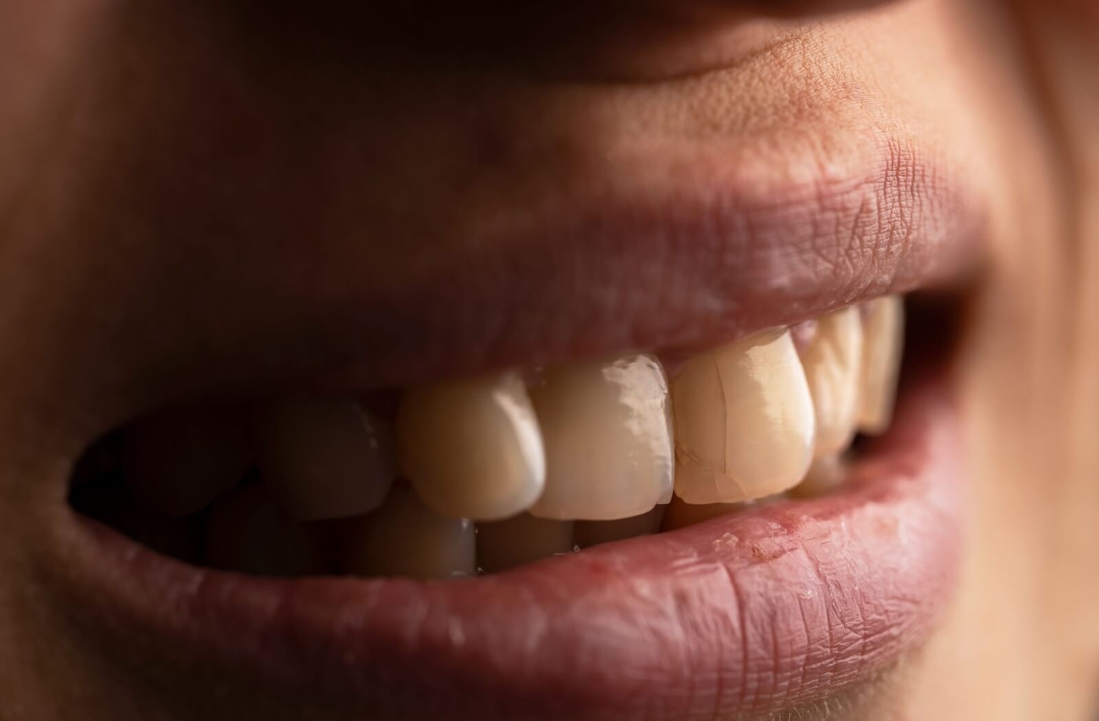 A close-up image of someone with a cracked front tooth.