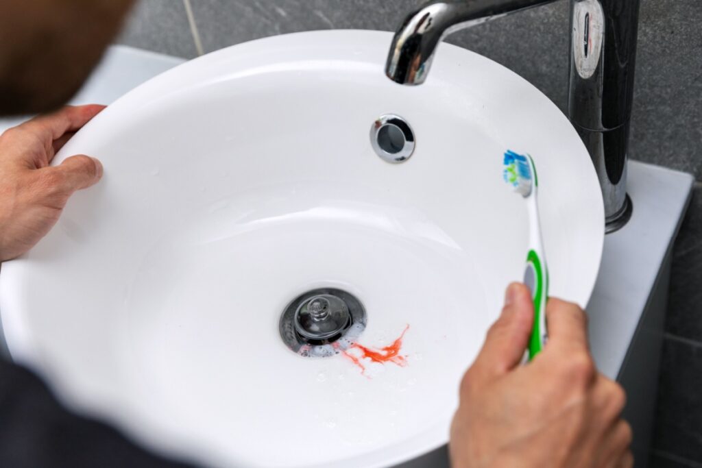 The view of a sink basin after someone spit after brushing their teeth, showing some blood from their gums after brushing.