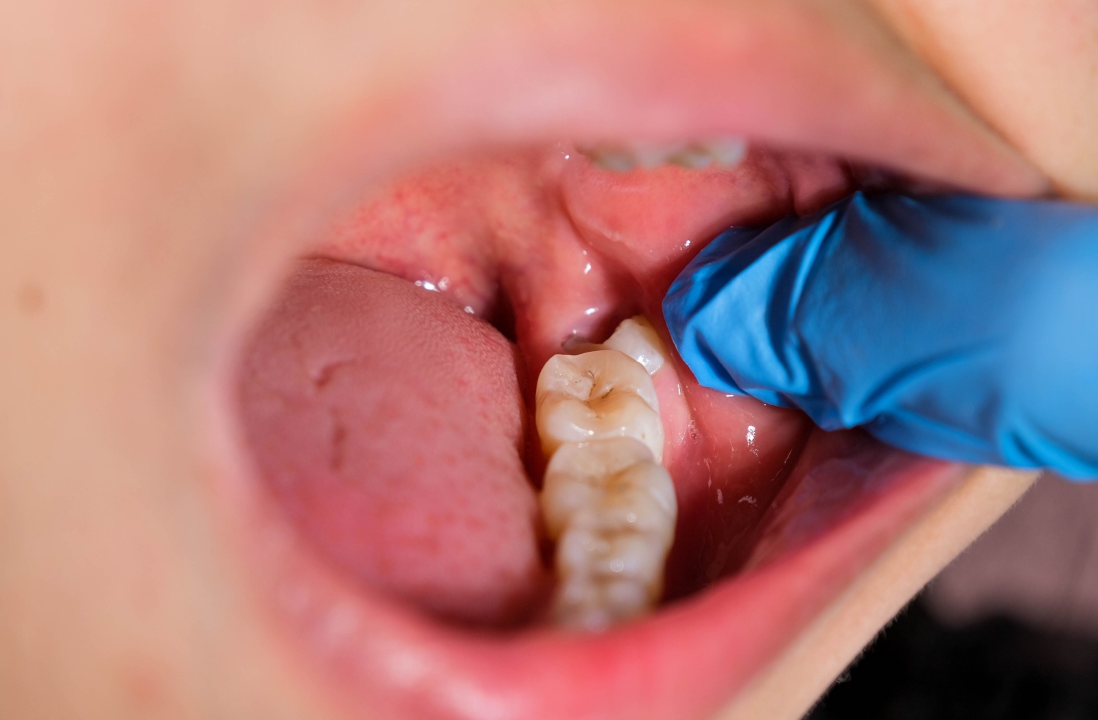 Inside of someones mouth showing a tooth erupting from the back of their mouth along their teeth