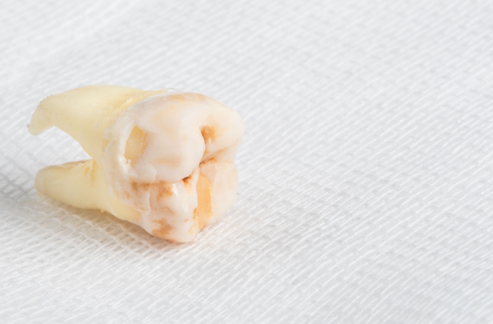 An extracted tooth resting on top of gauze