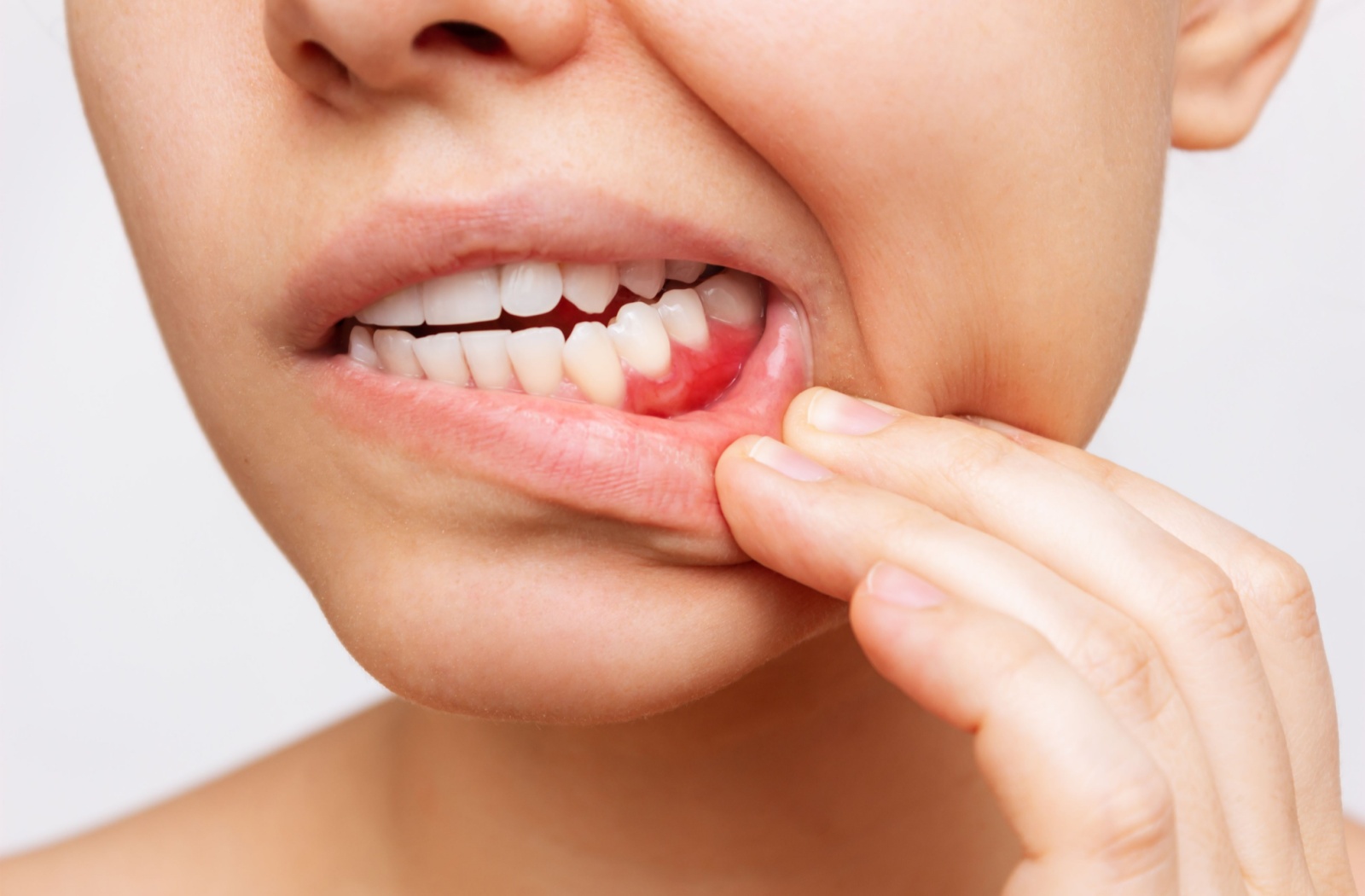 A close up of a person pulling their lip down to reveal red irritated gums
